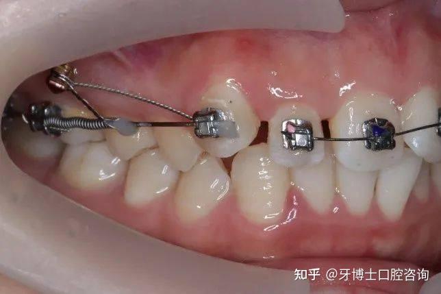 上海牙齿矫正费用
